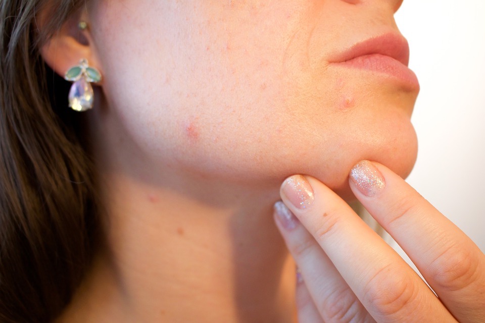 l'acné est issu des hormones